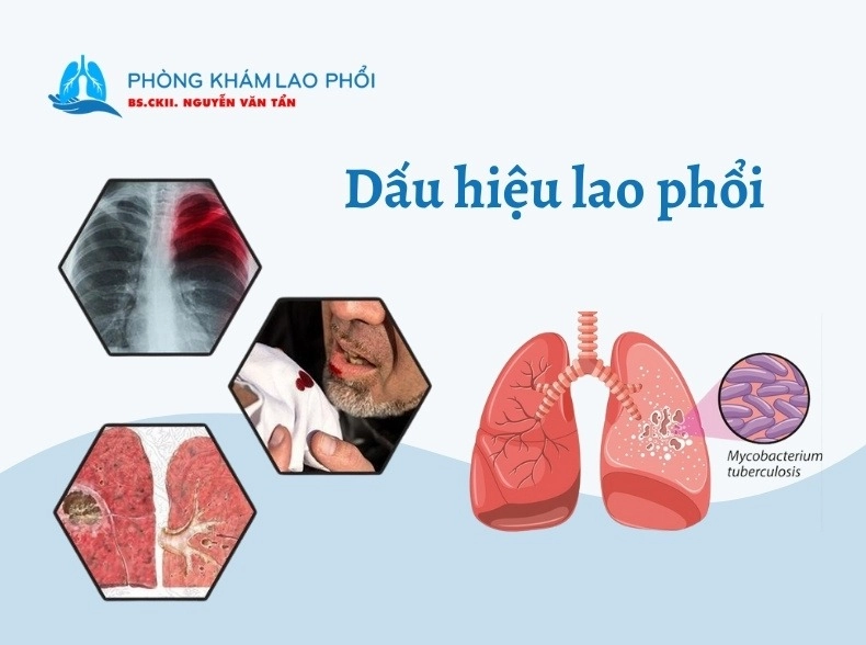 Dấu hiệu lao phổi: Ho khan kéo dài, ho ra máu và sụt cân